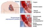 Болезни аорты и аортального клапана