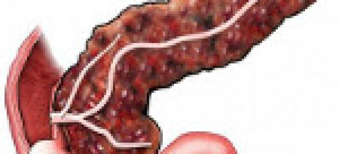 Фиброматоз поджелудочной железы