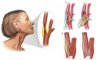 Как избавиться от бляшек в сосудах шеи