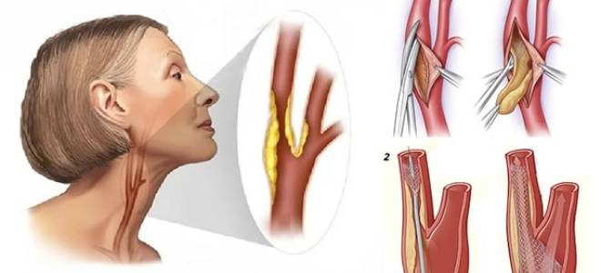 Как избавиться от бляшек в сосудах шеи