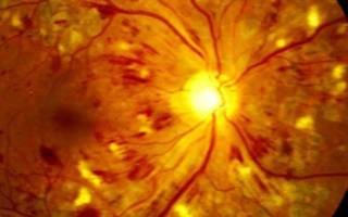 Лечение диабетической ретинопатии медикаментозное