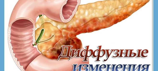 Умеренно выраженные диффузные изменения поджелудочной железы