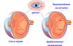 Что такое ретинопатия у больных сахарным Болезниом