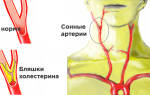 Атеросклеротические бляшки в сосудах шеи