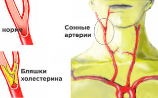Атеросклеротические бляшки в сосудах шеи